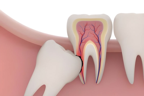 Răng khôn hay răng số 8 mọc ở vị trí trong cùng của cung hàm