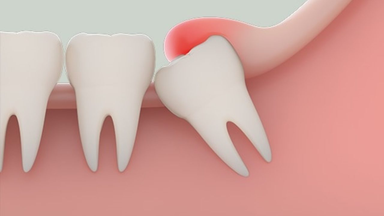 Quá trình nhổ răng khôn không còn quá đau nhờ vào kỹ thuật y khoa hiện đại