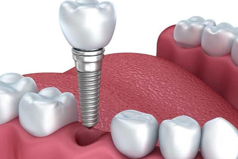 Phục Hồi Cấy Ghép Implant Pháp