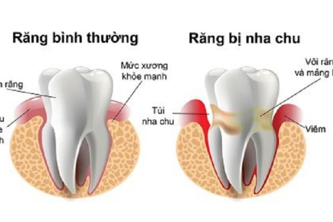 Phòng Ngừa Bệnh Nha Chu