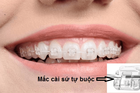 Chỉnh Nha Mắc Cài Sứ Tự Buộc