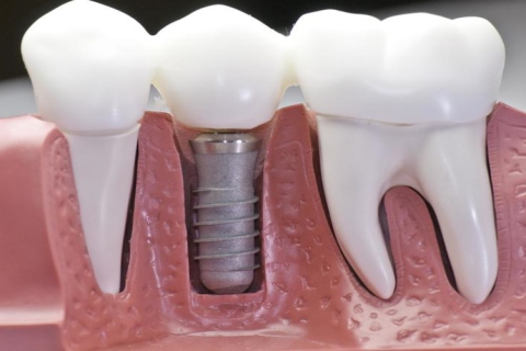 Phục Hồi Cấy Ghép Implant Mỹ