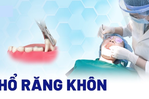 Tiểu Phẩu Răng Khôn