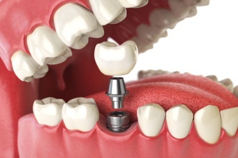 Phục Hồi Cấy Ghép Implant Hàn Quốc