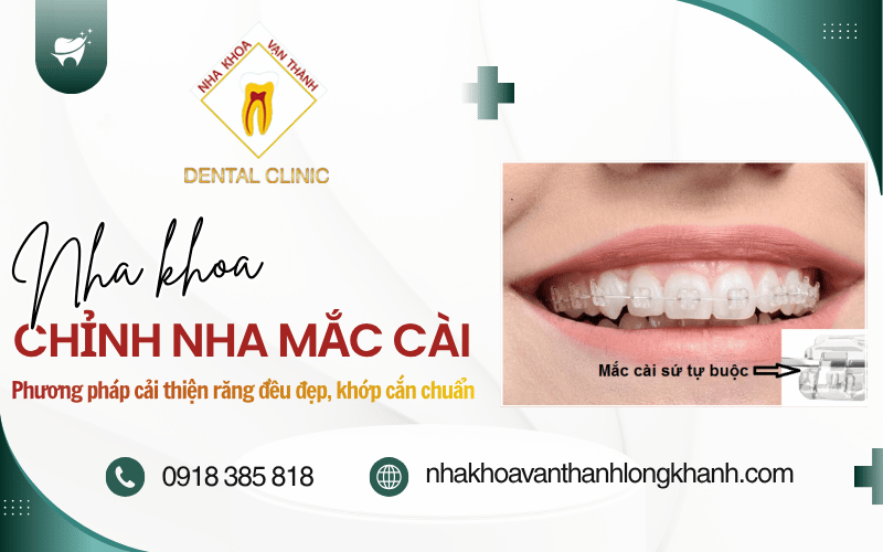 chỉnh nha mắc cài