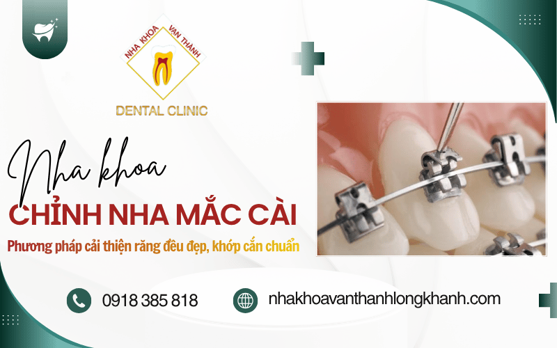 chỉnh nha mắc cài
