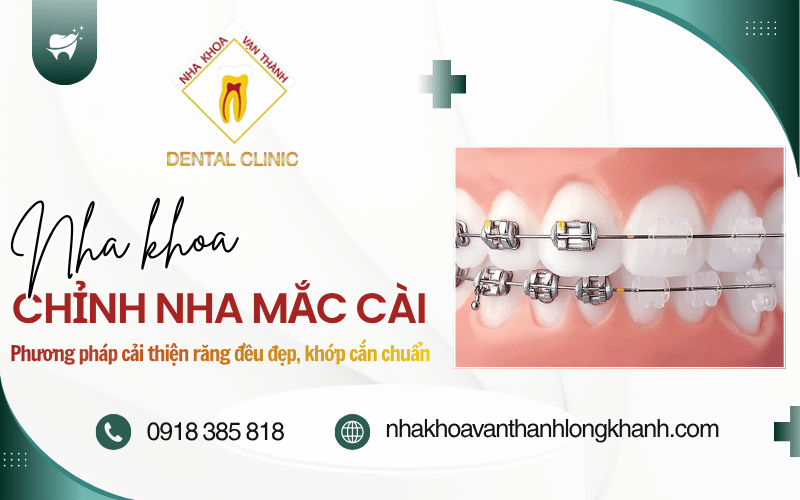 chỉnh nha mắc cài
