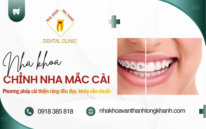 chỉnh nha mắc cài