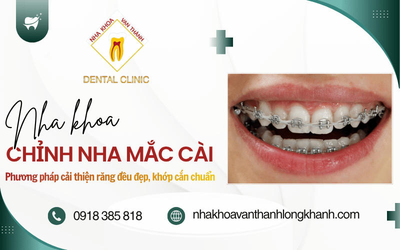 chỉnh nha mắc cài