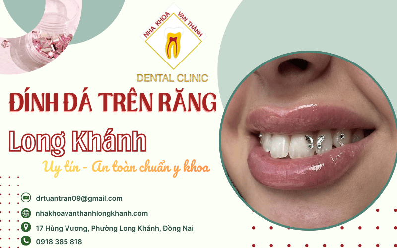đính đá trên răng