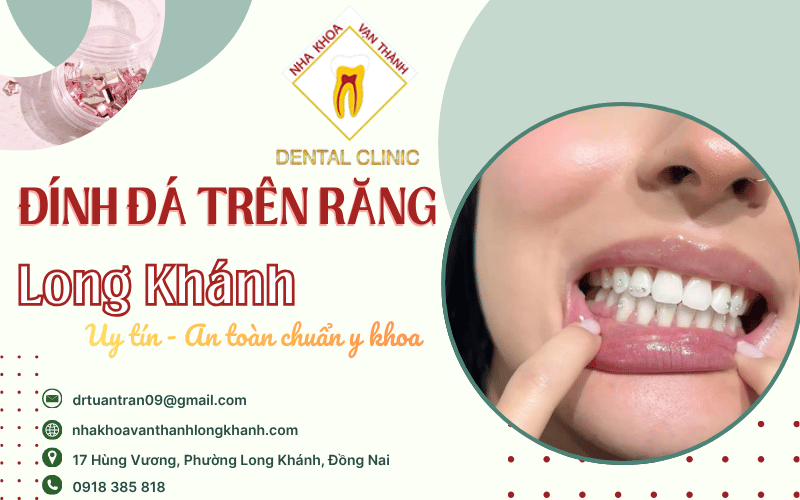 đính đá trên răng