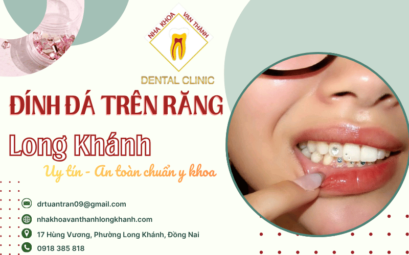 đính đá trên răng