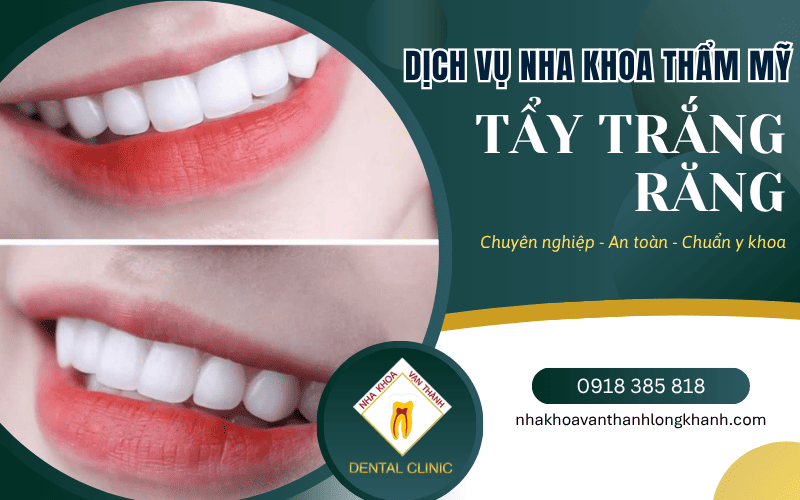 tẩy trắng răng
